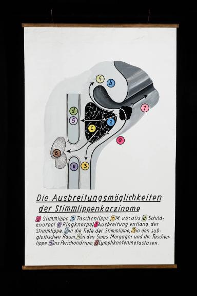 Die Metastasierung der Stimmlippenkarzinome