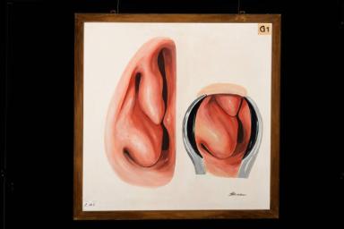 Unterer und mittlerer Nasengang der rechten Nasenhaupthöhle und 
vordere Naseninspektion mit dem Nasenspekulum