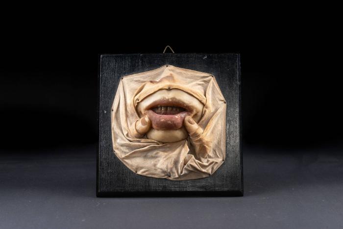 Plaques muqueuses (Lues)