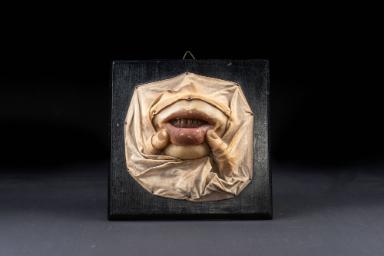 Plaques muqueuses (Lues)
