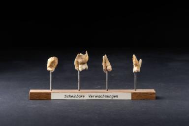 Scheinbare Verwachsung der Zähne
