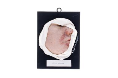 Adenoma sebaceum