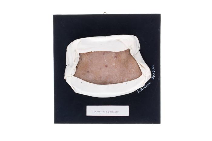 Dermatitis papillaris capillitii