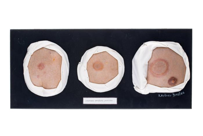 Erythema annulare perstans