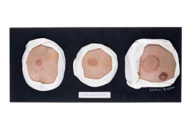 Erythema annulare perstans
