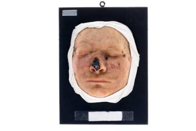 Xeroderma pigmentosum