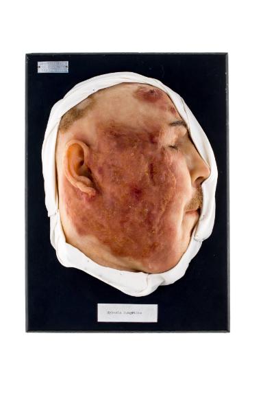 Mycosis Fungoides