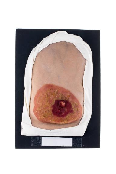 Paget-Syndrom