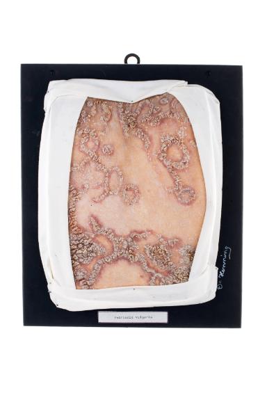 Psoriasis vulgaris