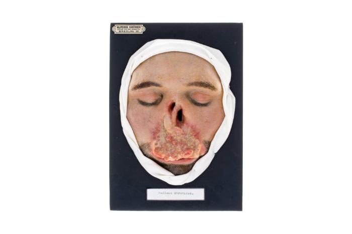 Malleus chronicus