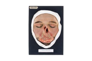 Malleus chronicus