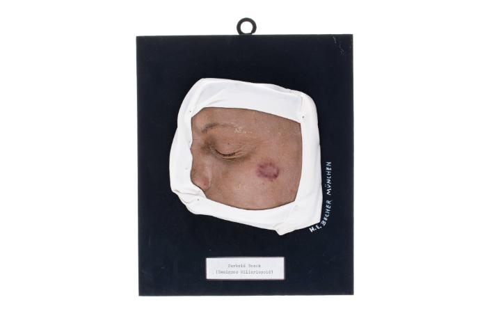 Boecksches Sarkoid