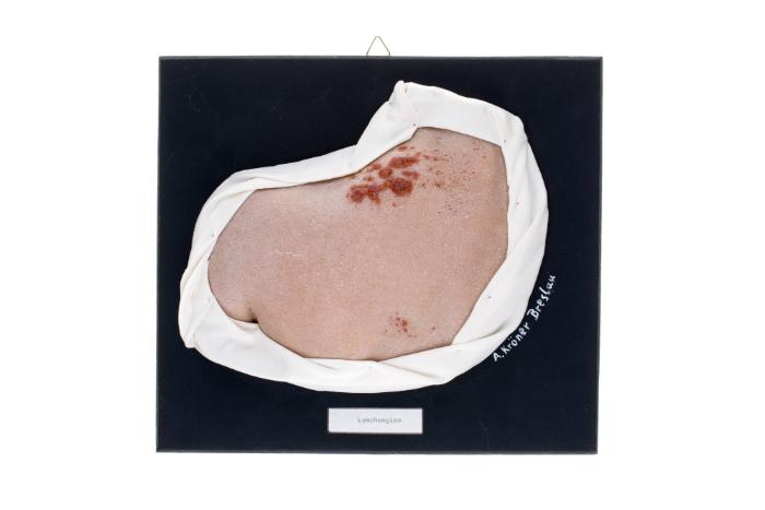 Lymphangiom