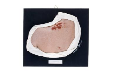 Lymphangiom