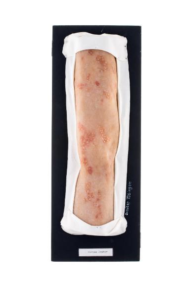 Herpes Zoster