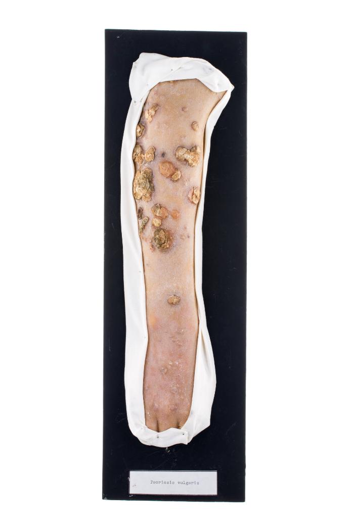 Psoriasis vulgaris