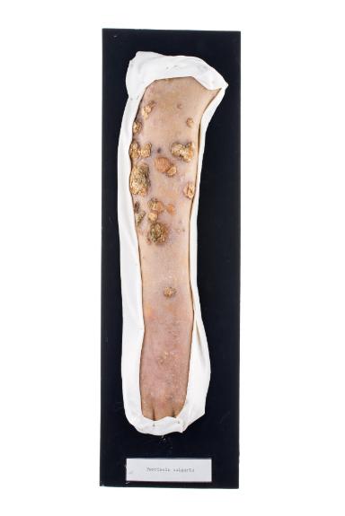 Psoriasis vulgaris