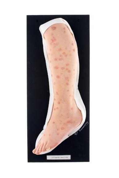 Urticaria