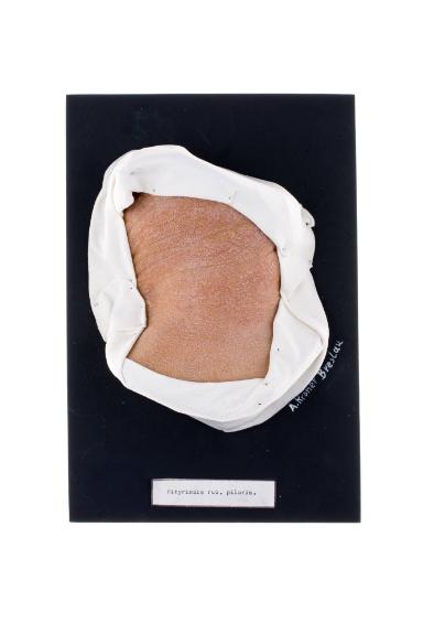 Pityriasis rubra pilaris