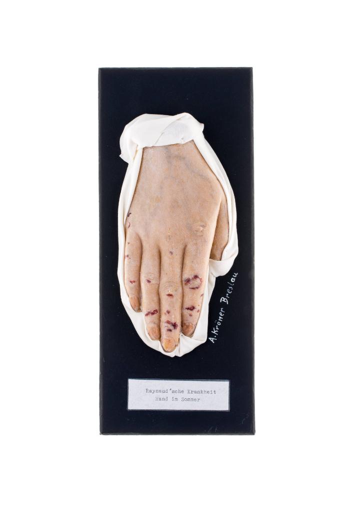 Raynaud'sche Krankheit