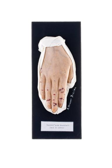 Raynaud'sche Krankheit