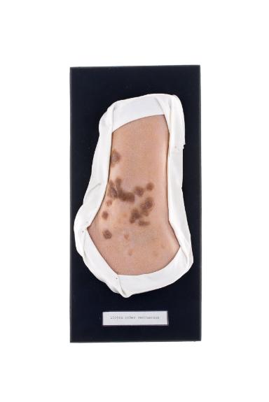 Lichen planus verrucosus