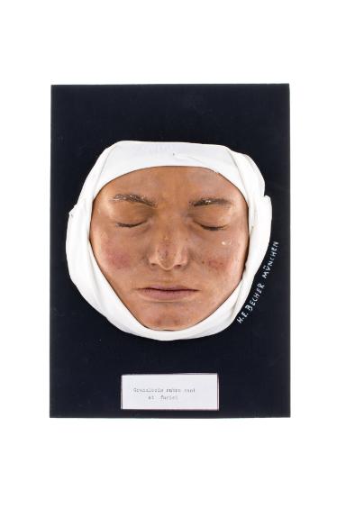 Granulosis rubra nasi et faciei