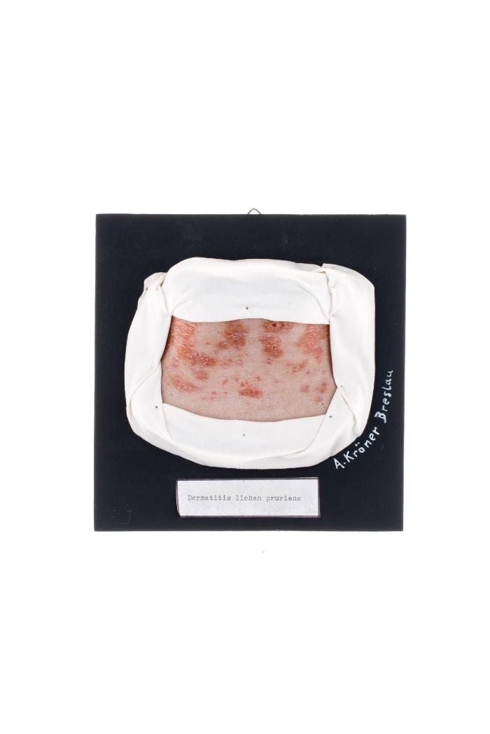 Dermatitis lichenoides pruriens