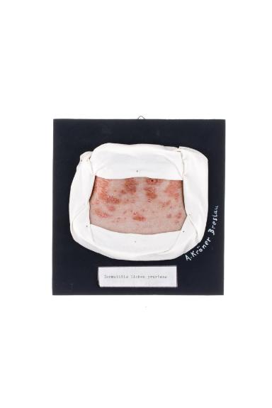 Dermatitis lichenoides pruriens