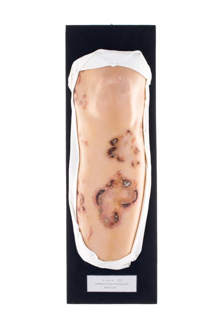 Lues III, tubero-ulcero-serpiginösem Syphilid