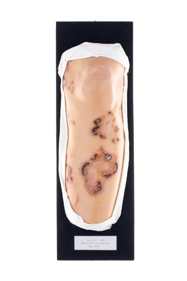 Lues III, tubero-ulcero-serpiginösem Syphilid