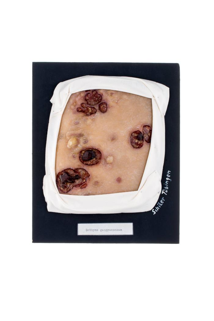 Ecthyma gangraenosum