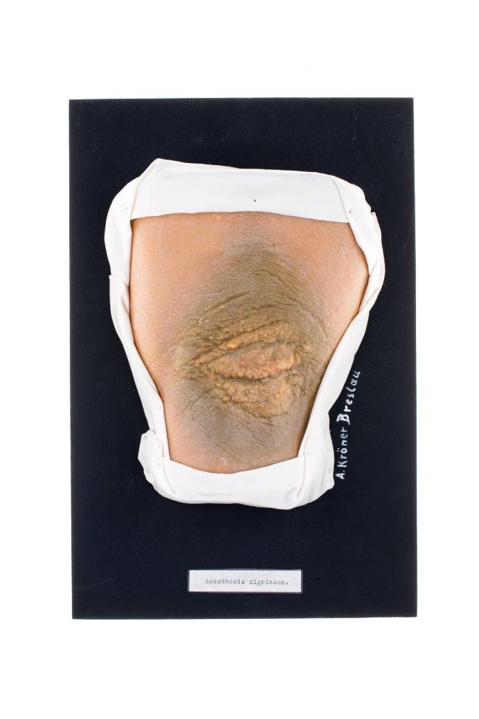 Acanthosis nigricans