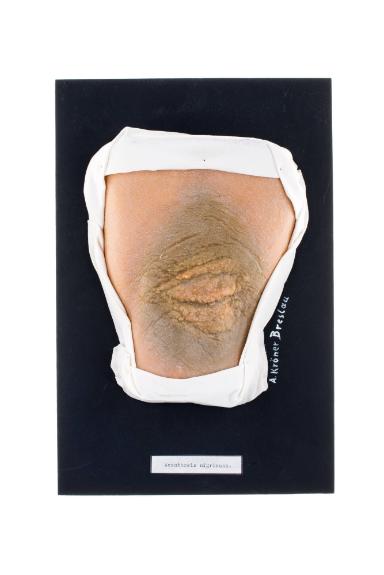 Acanthosis nigricans