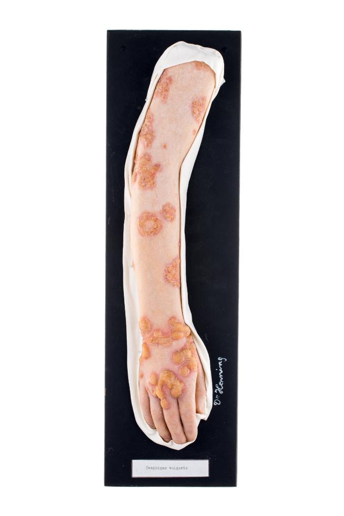 Pemphigus vulgaris