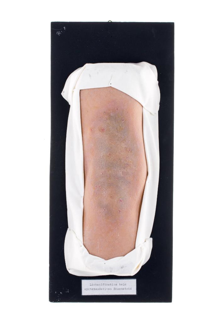 Lichenifikation beim spät- exsudativen Ekzematoid