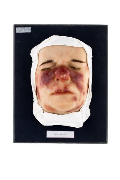 Lupus pernio