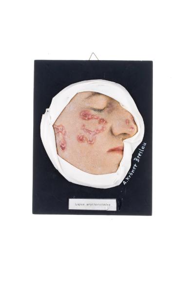 Lupus erythematodes