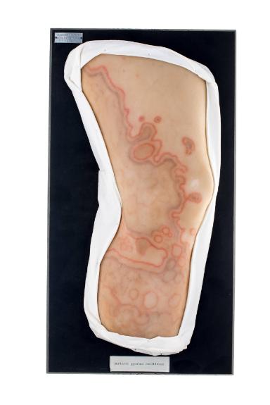 Erythema gyratum repens