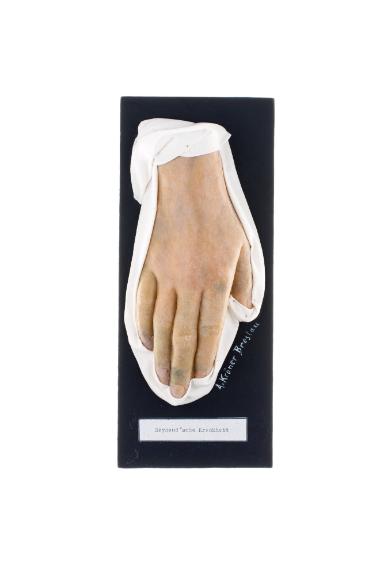 Raynaud'sche Krankheit