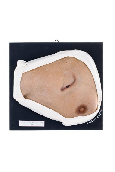 Mycosis fungoides sarcomat cutis