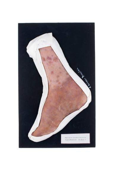 Multiple haemorrhagische Pigmentsarkom (Kaposi)
