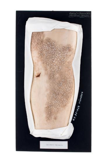 Keratosis verrucosa