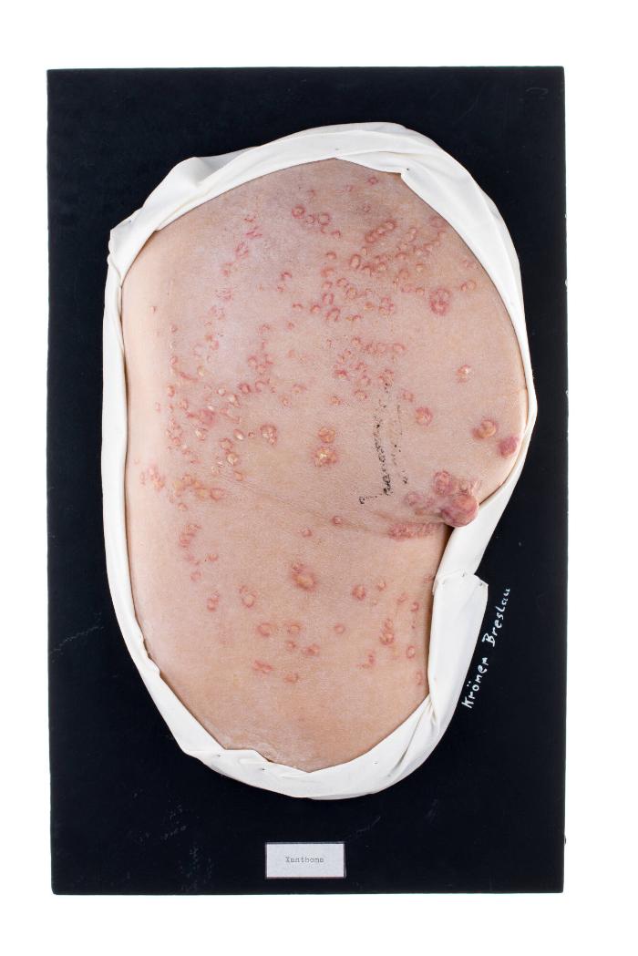 Xanthoma