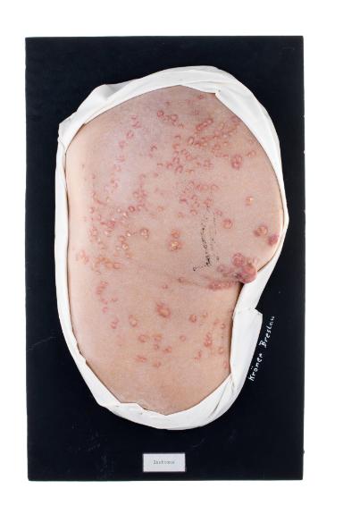 Xanthoma