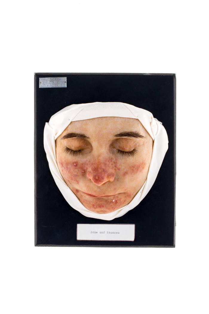 Akne und Rosacea