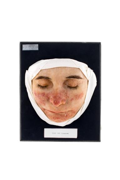 Akne und Rosacea